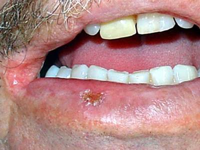 Estudo mostra aumento de casos de c�ncer oral na faixa de 30 a 44 anos