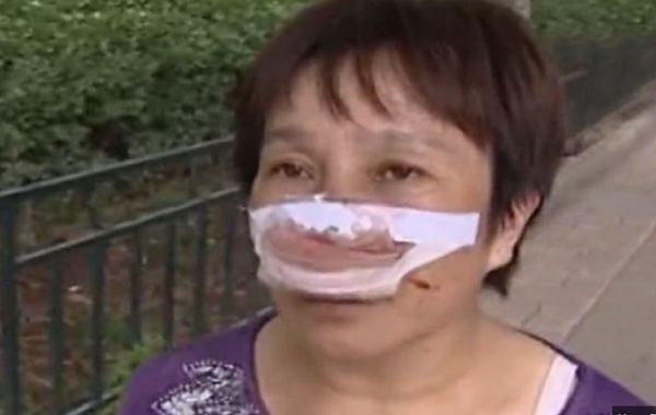 Viol�ncia: marido arranca nariz de mulher com os dentes