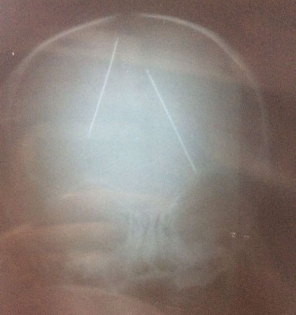 Beb� torturado com agulhas no cr�nio passa por nova cirurgia e incha�o impede retirada de objetos