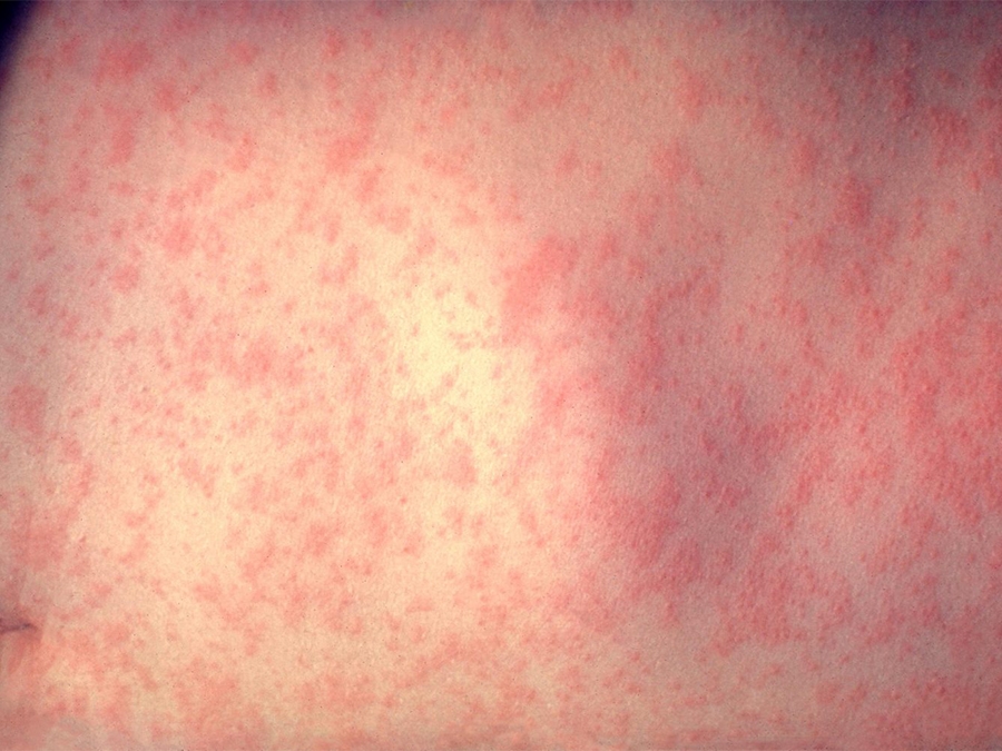 Campo Novo est� entre munic�pios que notifica casos de sarampo em Mato Grosso