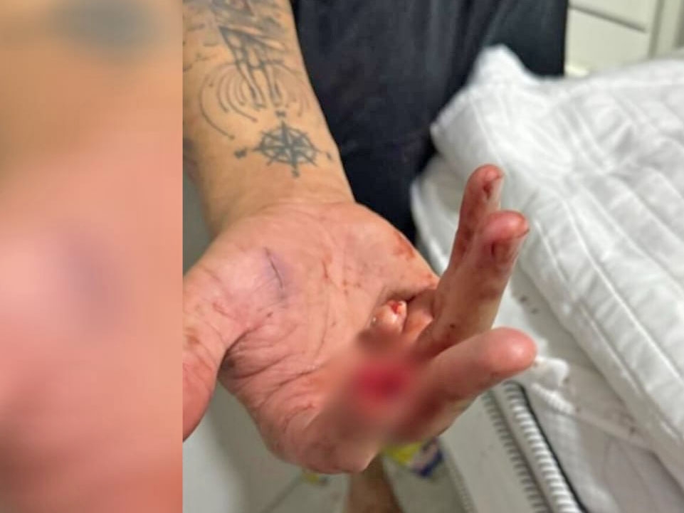 M�dico nega ter mordido e arrancado dedo do namorado da ex em Sinop