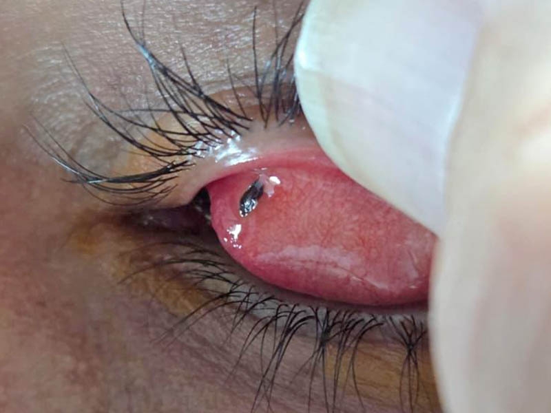 Oftalmologista de Juara alerta motociclistas e trabalhadores sobre riscos de corpos estranhos nos olhos.